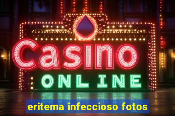 eritema infeccioso fotos
