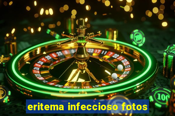 eritema infeccioso fotos