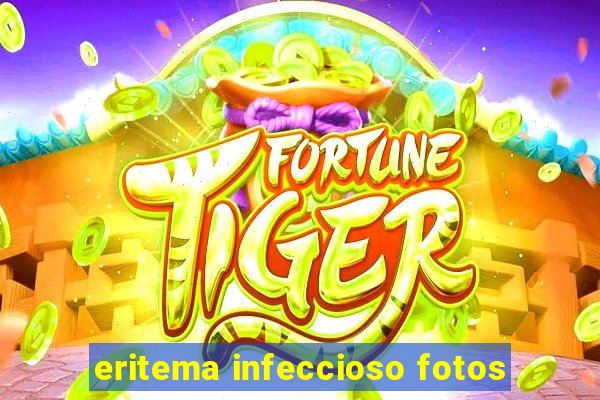 eritema infeccioso fotos